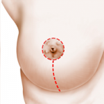 Gráfico incisión elevación de mamas