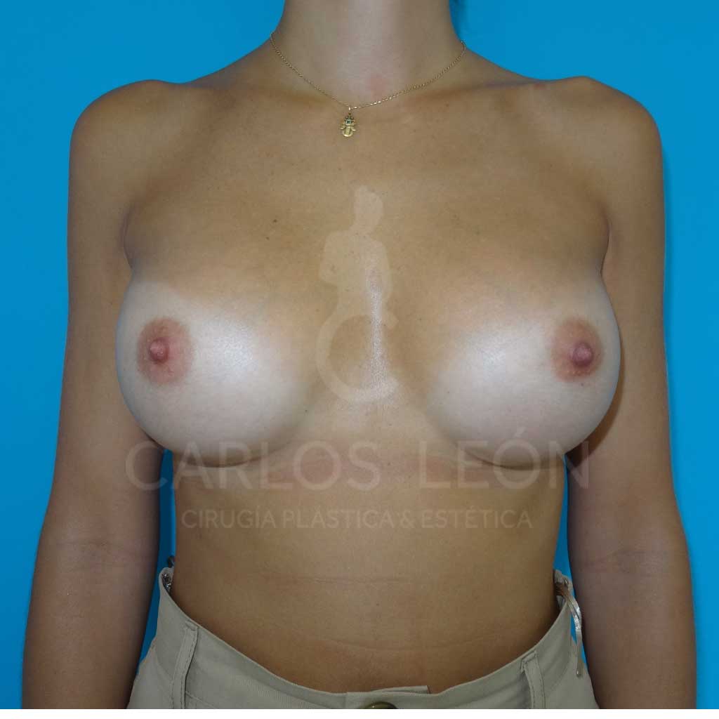 Caso 01 - Frontal - Después