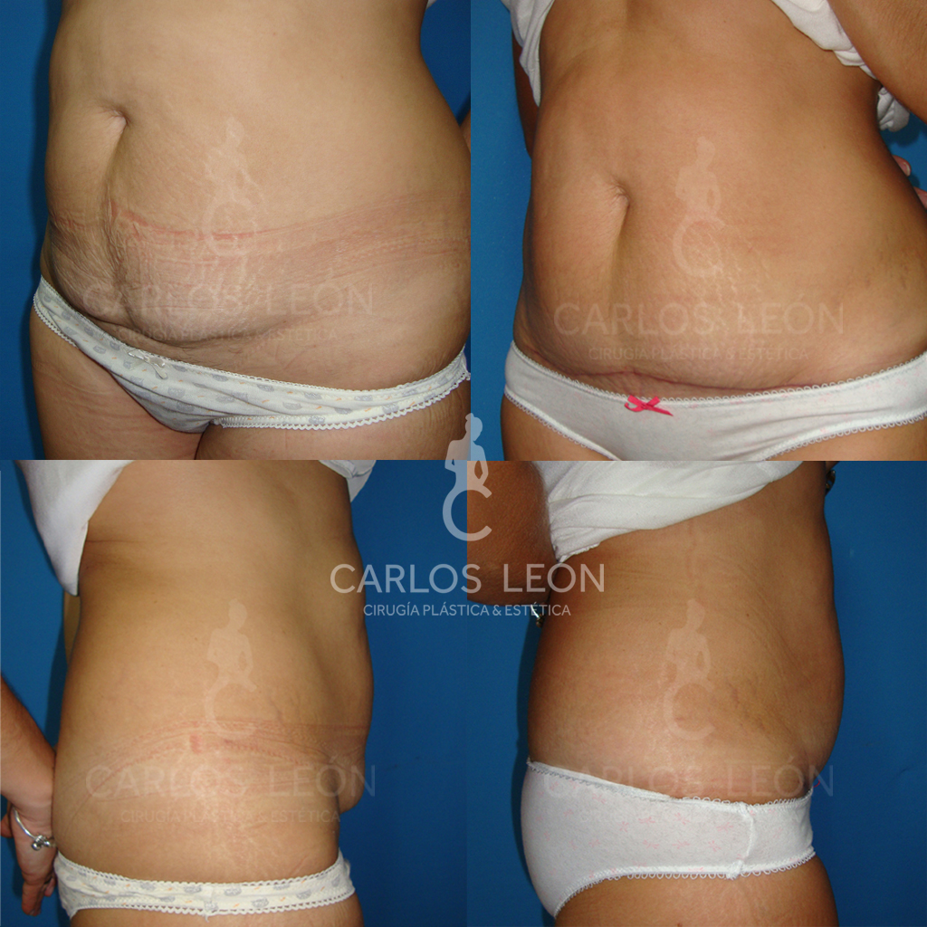 Foto Inicio ABDOMINOPLASTIA CASO 2