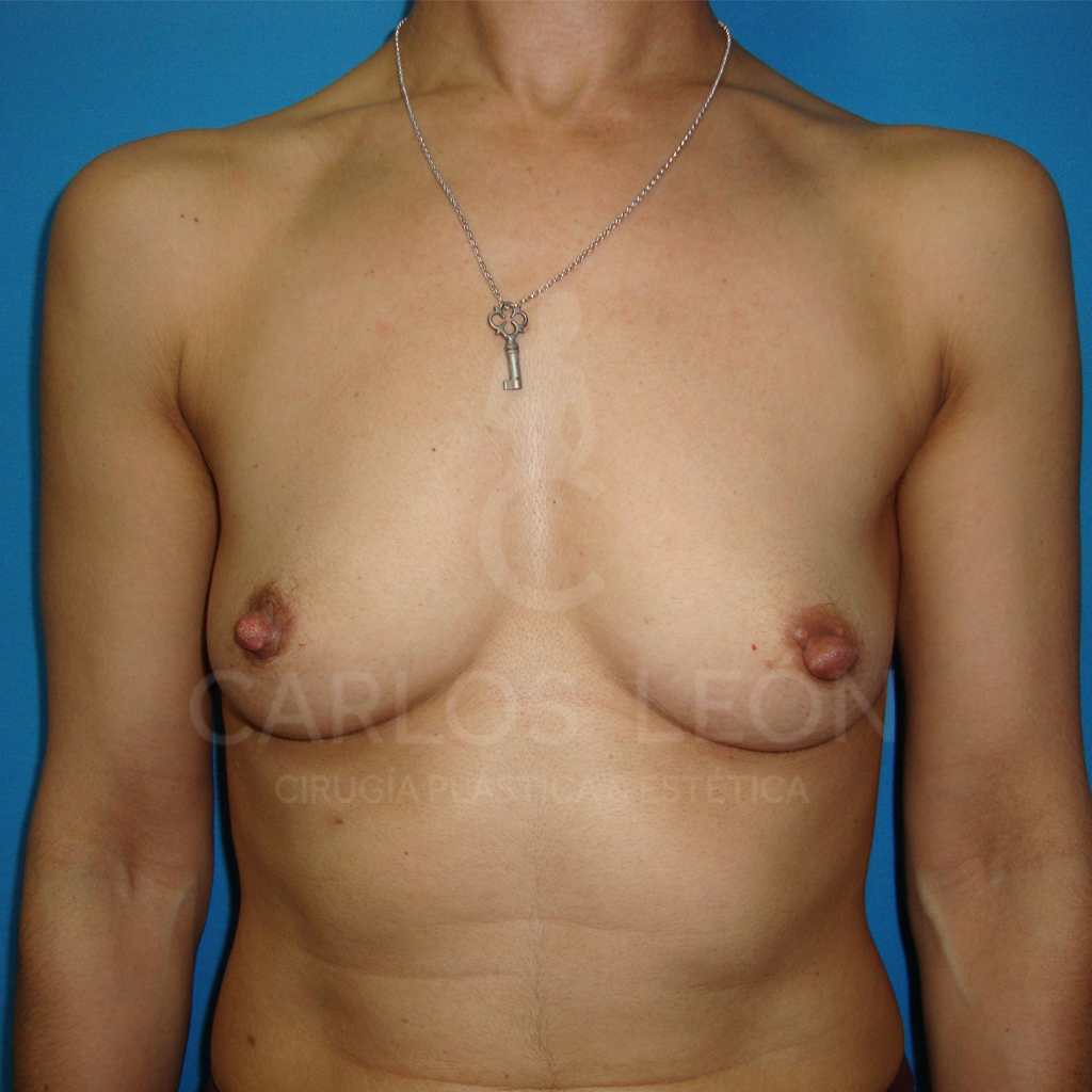 Frontal pre